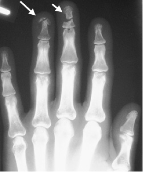 Finger Fracture - Hand & Elbow Conditions